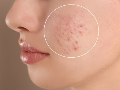 L’acne: un problema estetico che impatta anche sull’autostima